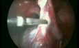 Surgery of Ovarian Cyst - Laparoscopic Method