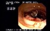 Metachronous Carcinoma