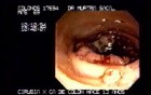 Metachronous Carcinoma