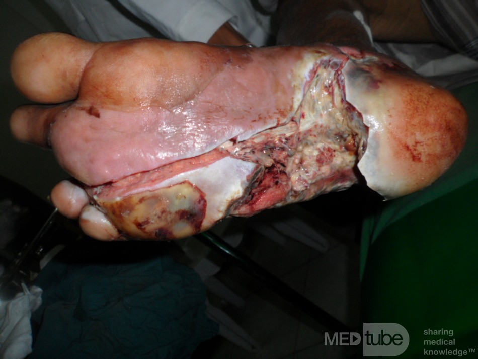 Neglected Infected Diabetic Foot