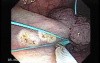 Huge Mass Of The Descending Colon (11 of 25)