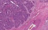 Adenocarcinoma - Histopathology of ovary