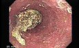Esophageal Achalasia - 65 Year-Old Female. Impaction of Foreign Body.