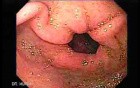 Stomach Cancer (1 of 2)