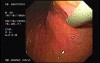 Flexible Endoscopic Suturing Device, Part 2