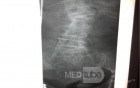 Fracture Compressions L1 With Spondiloarthrosis