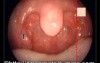 Tonsillar Enlargement Grading