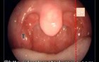 Tonsillar Enlargement Grading