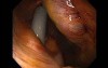 Gastrointestinal Stromal Tumor - GIST (33 of 65)