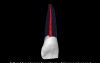 Maxillary Lateral Incisor
