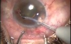 Neovascular Glaucoma - Transciliary Filtration