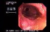 Ischemic Colitis