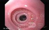 Congenital Esophageal Rings - Endoscopic Assessment of the Esophagus, Part 1