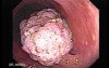 Tubulo-Villous Adenoma (6 of 6)