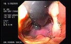 Acute Variceal Bleeding - Status Post Final Banding