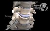 Anterior Discectomy and Interbody Fusion