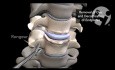Anterior Discectomy and Interbody Fusion