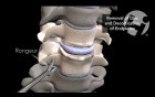 Anterior Discectomy and Interbody Fusion