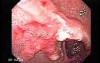 Multiple Adenomatous Polyps Of The Rectum (16 of 37)