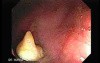 Status Post Rubber Band Ligation for Internal Hemorrhoids (1 of 7)