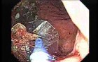 Achalasia - residual food (11 of 11)