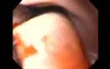 Massive Epistaxis - 76-year-old female patient - 5/8