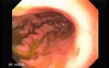 Gastroduodenal MALT lymphoma (1 of 9)