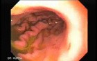 Gastroduodenal MALT lymphoma (1 of 9)