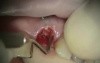 Immediate Implant And Transition With Stayplate