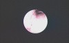 Hysteroscopy