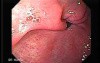 Watermelon Stomach (1 of 7) - Treatment with Argon Plasma Coagulator (APC)