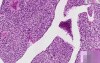 Transitional cell carcinoma