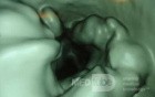 Adenocarcinoma of the Transverse Colon (2 of 15)
