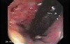 Tubulo - Villous Rectal Adenoma - Endoscopy (30 of 35)