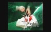 Haemorrhage Esophageal Cancer Surgery