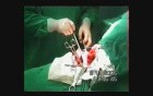 Haemorrhage Esophageal Cancer Surgery