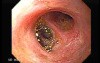 Choledocoduodenostomy and The Sump Syndrome (4 of 10)