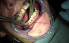 Jaw Fracture - Ivy Loop Placement Intraorally