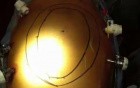 Laparoscopic incisional hernia repair