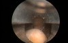 Bladder Stone - Post Greenlight HPS