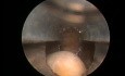 Bladder Stone - Post Greenlight HPS