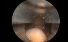 Bladder Stone - Post Greenlight HPS