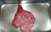 Adenocarcinoma of the cardias and gastric fundus with signet-ring cells (7 of 25)
