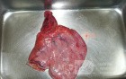Adenocarcinoma of the cardias and gastric fundus with signet-ring cells (7 of 25)