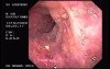 Lower Esophageal (Schatzki) Ring with esophageal varices and Reflux Esophagitis (1 of 2)