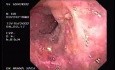 Lower Esophageal (Schatzki) Ring with esophageal varices and Reflux Esophagitis (1 of 2)