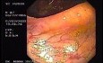 Ulcerative Colitis Of Long Stand Evolution (2 of 3)