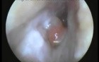 An Immflamatory Polyp Of The Ear Passage - Suction Clearance