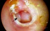 Chronic Suppurative Otitis Media: Active Stage