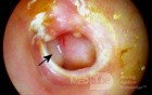 Chronic Suppurative Otitis Media: Active Stage